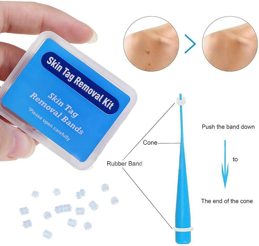 Extra Vascular Micro-Bands