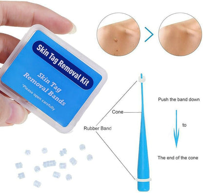 Extra Vascular Micro-Bands