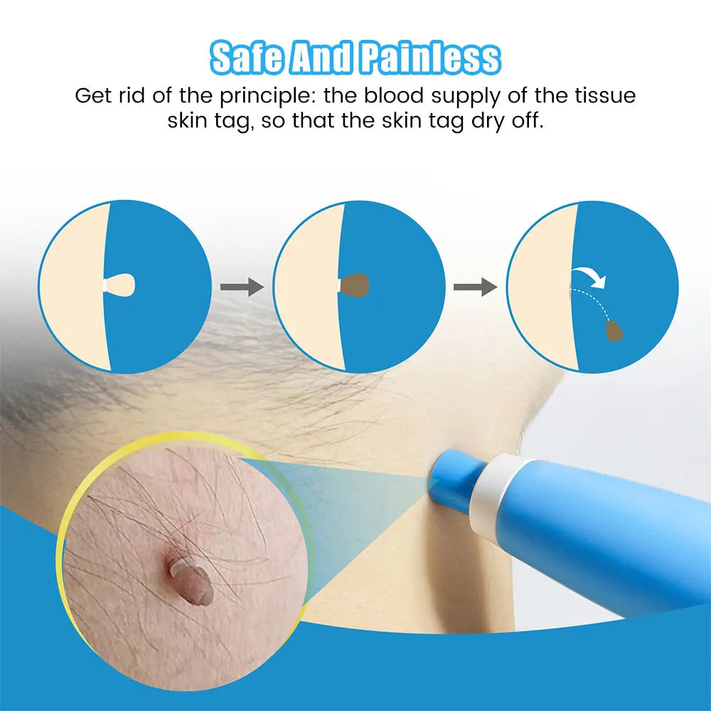 TagBuddy: Skin Tag Remover